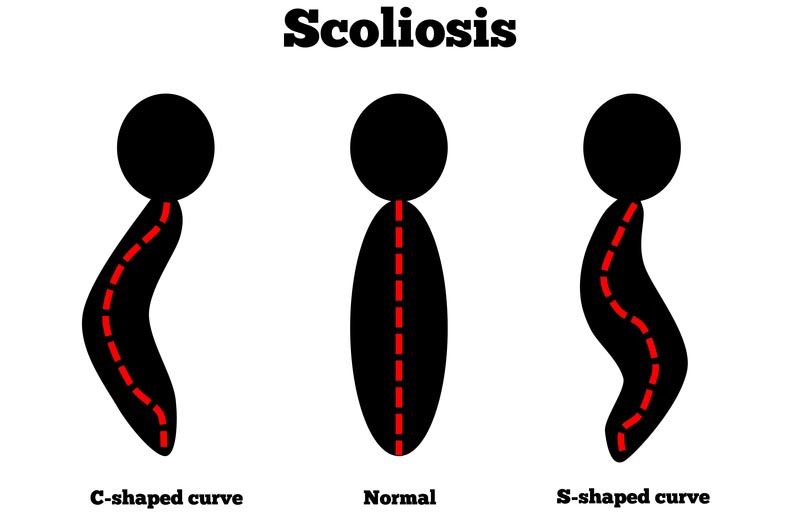 Alexandria, KY scoliosis treatment